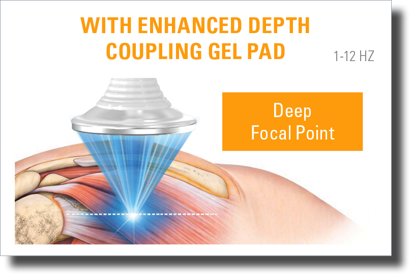 DualWave FX focused shockwave therapy applicator with enhanced depth coupling gel pad showing deep focal point targeting within musculoskeletal tissue.