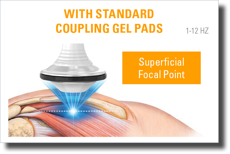 DualWave FX focused shockwave therapy applicator with standard coupling gel pad illustrating superficial focal point targeting in the tissue.